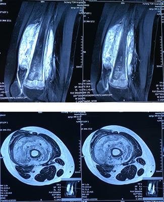 Case Report: Hyperplastic Callus of the Femur Mimicking Osteosarcoma in Osteogenesis Imperfecta Type V